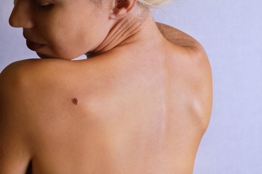 woman looking at mole on her back